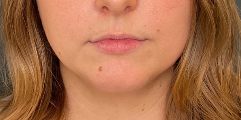 Lip Filler Before & After Image