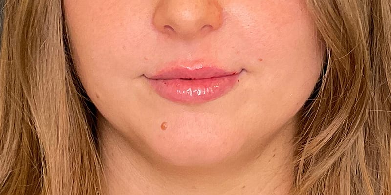 Lip Filler Before & After Image