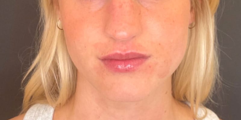 Lip Filler Before & After Image