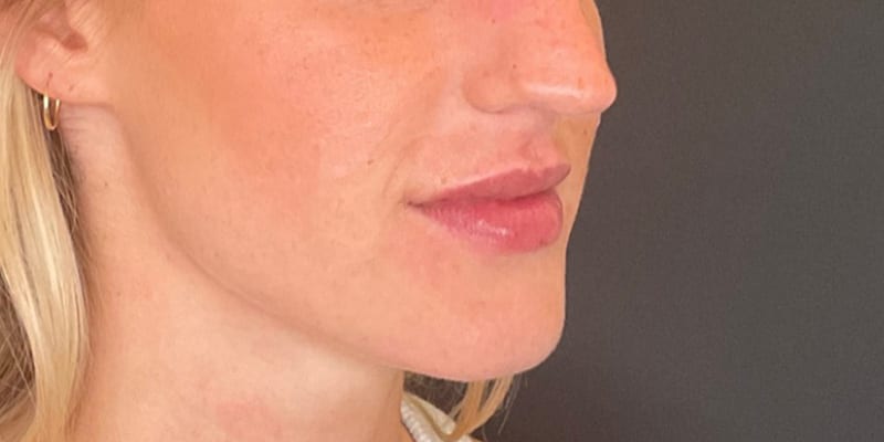 Lip Filler Before & After Image